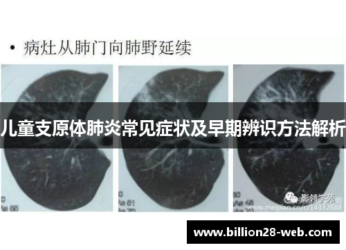儿童支原体肺炎常见症状及早期辨识方法解析